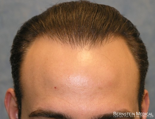can you regrow hair with propecia